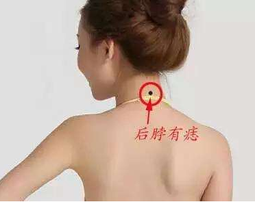 脖子后面有痣代表什么,男女脖子后面有痣圖解 脖子后面有痣代表什么,男女脖子后面有痣圖解